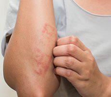Eczema & Hives